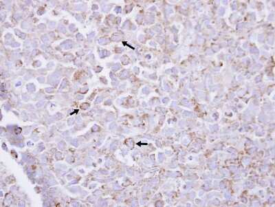 Immunohistochemistry-Paraffin: PIP5K1 alpha Antibody [NBP2-19833] -  CL1-0 xenograft, using PIPK I alpha antibody at 1:100 dilution.Antigen Retrieval: Citrate buffer, pH 6.0, 15 min.