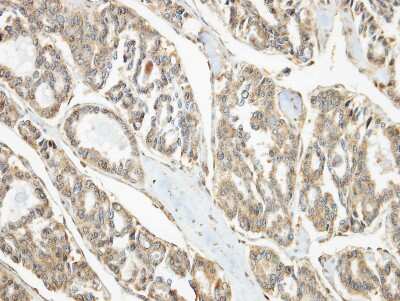 Immunohistochemistry-Paraffin: PIP5K2 alpha Antibody [NBP2-19835] - Immunohistochemical analysis of paraffin-embedded tyroid ca, using antibody at 1:100 dilution.
