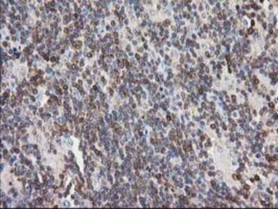 Immunohistochemistry: PIP5K2 alpha Antibody (OTI3D3) - Azide and BSA Free [NBP2-73417] - Staining of paraffin-embedded Human lymphoma tissue using anti-PIP5K2 alpha mouse monoclonal antibody.