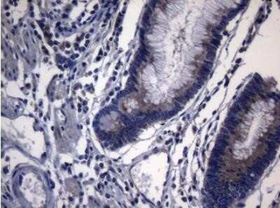 Immunohistochemistry: PITPNB Antibody (OTI6H10) - Azide and BSA Free [NBP2-73421] - Staining of paraffin-embedded Adenocarcinoma of Human colon tissue using anti PITPNB mouse monoclonal antibody. (Heat-induced epitope retrieval by 1mM EDTA in 10mM Tris buffer (pH8.5) at 120 degrees C for 3 min, 1:150)