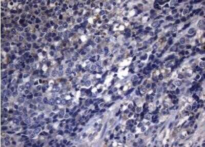 Immunohistochemistry: PITPNB Antibody (OTI6H10) - Azide and BSA Free [NBP2-73421] - Staining of paraffin-embedded Carcinoma of Human bladder tissue using anti-PITPNB mouse monoclonal antibody.(Heat-induced epitope retrieval by 1mM EDTA in 10mM Tris buffer (pH8.5) at 120 degrees C for 3 min, (1:150)