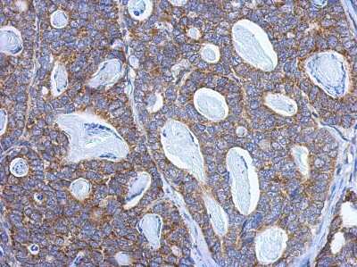 Immunohistochemistry-Paraffin: PITRM1 Antibody [NBP2-19844] - Analysis of paraffin-embedded Gastric ca, using antibody at 1:500 dilution.