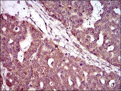 Immunohistochemistry: PIWIL4 Antibody (10G9B11) [NBP2-37398] - Immunohistochemical analysis of paraffin-embedded ovarian cancer tissues using PIWIL4 mouse mAb with DAB staining.