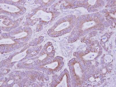 Immunohistochemistry-Paraffin: PKA 2 beta Antibody [NBP1-33773] - Human colon carcinoma, using PKA 2 beta antibody at 1:500 dilution.Antigen Retrieval: Citrate buffer, pH 6.0, 10 min.