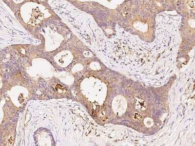 Immunohistochemistry-Paraffin: PKA C alpha Antibody [NBP2-99335] - Immunochemical staining of human PKA C alpha in human colon carcinoma with rabbit polyclonal antibody at 1:200 dilution, formalin-fixed paraffin embedded sections.