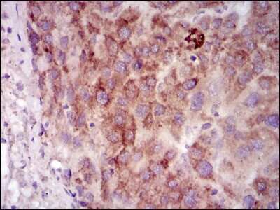 Immunohistochemistry-Paraffin: PKA C-gamma Antibody (2E4) [NBP2-37487] - Analysis of liver cancer tissues using PRKACG mouse mAb with DAB staining.