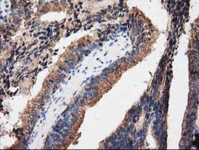 Immunohistochemistry: PKA R2 Antibody (OTI1F8) - Azide and BSA Free [NBP2-73428] - Staining of paraffin-embedded Carcinoma of Human prostate tissue using anti-PKA R2 mouse monoclonal antibody.