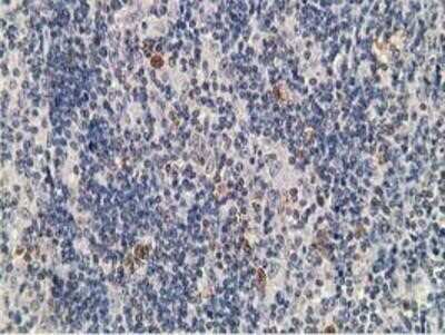 Immunohistochemistry: PKA RI beta Antibody (OTI2A3) - Azide and BSA Free [NBP2-73430] - Staining of paraffin-embedded Human lymphoma tissue using anti-PKA regulatory subunit I beta mouse monoclonal antibody.