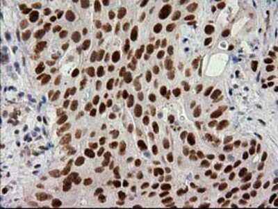 Immunohistochemistry-Paraffin: PKC epsilon Antibody (4G8) [NBP2-03620] - Staining of paraffin-embedded Carcinoma of Human bladder tissue using anti-PKC epsilon mouse monoclonal antibody.