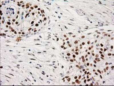 Immunohistochemistry-Paraffin: PKC epsilon Antibody (4G8) [NBP2-03620] - Staining of paraffin-embedded Carcinoma of Human pancreas tissue using anti-PKC epsilon mouse monoclonal antibody.