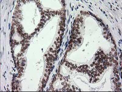 Immunohistochemistry-Paraffin: PKC epsilon Antibody (4G8) [NBP2-03620] - Staining of paraffin-embedded Carcinoma of Human prostate tissue using anti-PKC epsilon mouse monoclonal antibody.