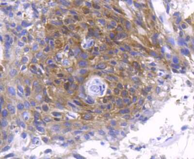 Immunohistochemistry-Paraffin: PKC zeta [p Thr560] Antibody (SN0753) [NBP2-67713] - Analysis of paraffin-embedded human breast carcinoma tissue using anti-Phospho-PKC zeta(T560) antibody. Counter stained with hematoxylin.