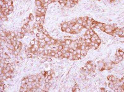 Immunohistochemistry-Paraffin: PKLR Antibody [NBP2-20027] - Human breast cancer, using Pyruvate Kinase (liver/RBC)  antibody at 1:250 dilution.Antigen Retrieval: Trilogy™ (EDTA based, pH 8.0) buffer, 15min.