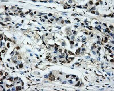 Immunohistochemistry: PKMYT1 Antibody (OTI5E1) - Azide and BSA Free [NBP2-73452] - Staining of paraffin-embedded Adenocarcinoma of Human breast tissue using anti-PKMYT1 mouse monoclonal antibody.