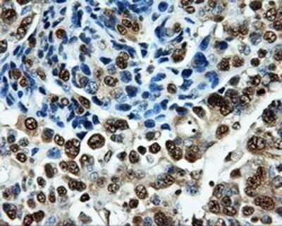 Immunohistochemistry: PKMYT1 Antibody (OTI5E1) - Azide and BSA Free [NBP2-73452] - Staining of paraffin-embedded Adenocarcinoma of Human ovary tissue using anti-PKMYT1 mouse monoclonal antibody.