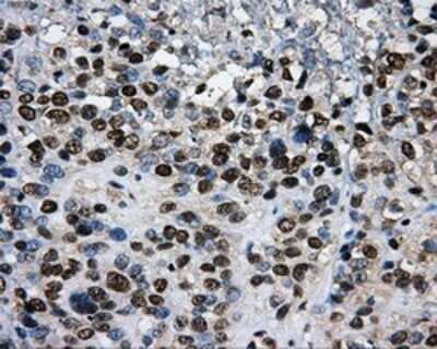 Immunohistochemistry: PKMYT1 Antibody (OTI5E1) - Azide and BSA Free [NBP2-73452] - Staining of paraffin-embedded Carcinoma of Human bladder tissue using anti-PKMYT1 mouse monoclonal antibody.