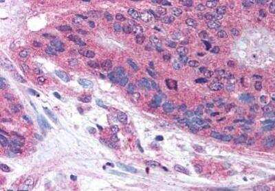 Immunohistochemistry-Paraffin: PLA2G3 Antibody [NB100-59030] - Analysis of anti-PLA2G3 antibody with human colon, carcinoma at concentration 10 ug/ml.