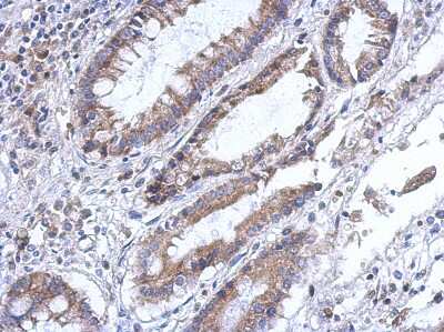 Immunohistochemistry-Paraffin: PLA2G4F Antibody [NBP2-19854] - Immunohistochemical analysis of paraffin-embedded Gastric ca, using antibody at 1:500 dilution.