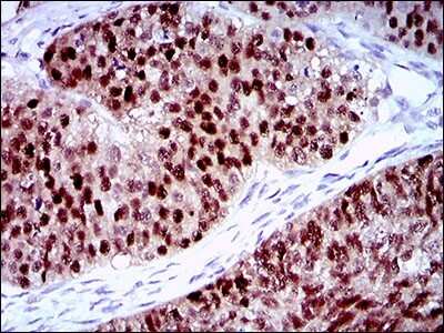 Immunohistochemistry-Paraffin: PLAGL1 Antibody (8D8C5) [NBP2-37343] - Analysis of ovarian cancer tissues using PLAGL1 mouse mAb with DAB staining.