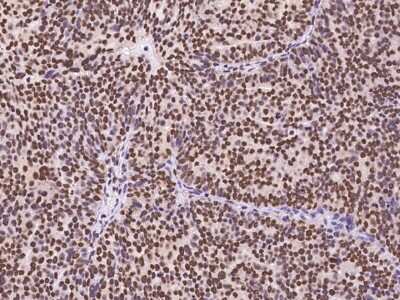 Immunohistochemistry-Paraffin: PLAGL1 Antibody [NBP3-06208] - Immunochemical staining of human PLAGL1 in human ovarian cancer with rabbit polyclonal antibody at 1:100 dilution, formalin-fixed paraffin embedded sections.