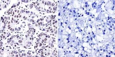 Immunohistochemistry-Paraffin: PLC-gamma 1 Antibody (2C11) [NB100-74517] - Cancer biopsies of deparaffinized human hepatocarcinoma.