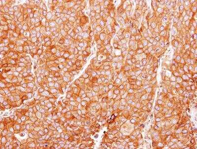 Immunohistochemistry-Paraffin: PLC-gamma 2 Antibody [NBP1-33122] - Paraffin-embedded BT474 xenograft, using antibody at 1:100 dilution.