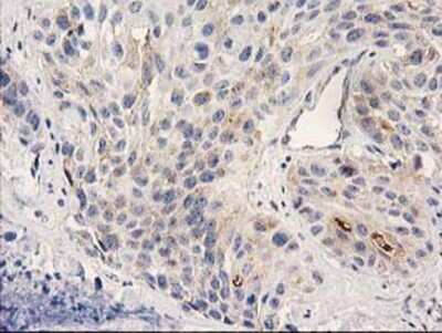 Immunohistochemistry-Paraffin: PLEKHA3 Antibody (5D11) [NBP2-00768] - Staining of paraffin-embedded Carcinoma of Human bladder tissue using anti-PLEKHA3 mouse monoclonal antibody.