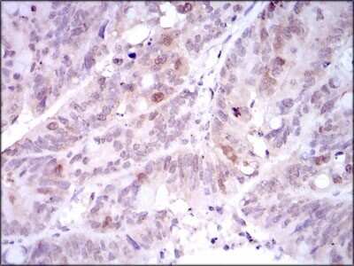 Immunohistochemistry-Paraffin: PLK1 Antibody (3C11) [NBP2-22196] - Immunohistochemical analysis of paraffin-embedded rectum cancer tissues using PLK1 mouse mAb with DAB staining.