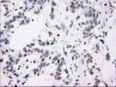 Immunohistochemistry: PLK1 Antibody (OTI1D4) - Azide and BSA Free [NBP2-73472] - Staining of paraffin-embedded Adenocarcinoma of Human endometrium tissue using anti-PLK1 mouse monoclonal antibody.