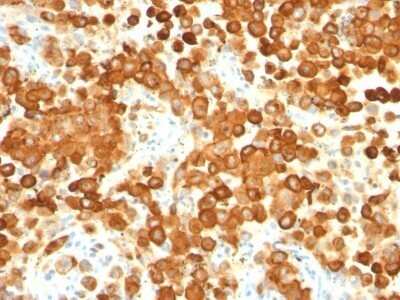 Immunohistochemistry-Paraffin: PMEL17/SILV Antibody (HMB45 + PMEL/783) - Azide and BSA Free [NBP2-47780] - Human Melanoma stained with gp100 / Melanosome Monoclonal Antibody (HMB45 + PMEL/783).