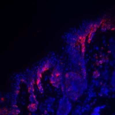 Immunohistochemistry: PMEL17/SILV Antibody (HMB45) - Azide and BSA Free [NBP2-34638] - PMEL17 (red) was detected in human skin (melanoma) using PMEL17-PE antibody (1:200) in PBS for 1 hour. Nuclei were stained with DAPI (blue). Image from a verified customer review. Image using the PE format of this antibody.