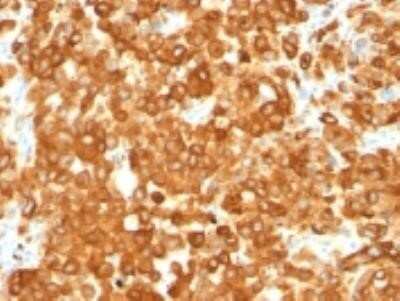 Immunohistochemistry-Paraffin: PMEL17/SILV Antibody (HMB45) - Azide and BSA Free [NBP2-34638] - Formalin-fixed, paraffin-embedded human melanoma stained with gp100/Melanosome Monoclonal Antibody (HMB45).