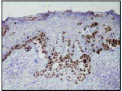 Immunohistochemistry-Paraffin: PMEL17/SILV Antibody (P14-V) [NBP1-79001] - Diffuse anti Melanosome antibody positivity in the cutaneous malignant melanoma. Formalin fixed, paraffin embedded human tissue (4 um section) stained with anti -Melanosome (DB 049) monospecific clonal antibody.