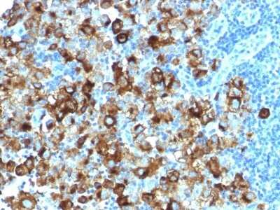 Immunohistochemistry-Paraffin: PMEL17/SILV Antibody (PMEL/1825R) - Azide and BSA Free [NBP2-54454] - Formalin-fixed, paraffin-embedded human Melanoma stained with gp100 Recombinant Rabbit Monoclonal Antibody (PMEL/1825R).