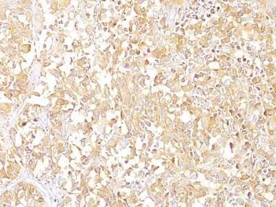 Immunohistochemistry-Paraffin: PMEL17/SILV Antibody (SPM142) - Azide and BSA Free [NBP2-34739] - Formalin-fixed, paraffin-embedded human melanoma (10X) stained with gp100 / Melanosome MAb (SPM142).