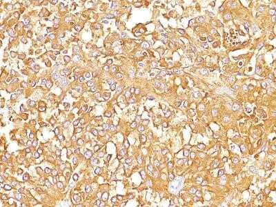 Immunohistochemistry-Paraffin: PMEL17/SILV Antibody (SPM142) - Azide and BSA Free [NBP2-34739] - Formalin-fixed, paraffin-embedded human melanoma (20X) stained with gp100 / Melanosome MAb (SPM142).