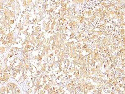 Immunohistochemistry-Paraffin: PMEL17/SILV Antibody (SPM142) - IHC-Prediluted [NBP2-44521] - Formalin-fixed, paraffin-embedded human melanoma (10X) stained with gp100 / Melanosome MAb (SPM142).