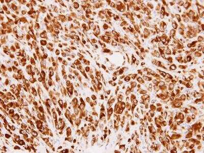 Immunohistochemistry-Paraffin: PMM2/Phosphomannomutase 2 Antibody [NBP1-33750] - Paraffin-embedded U87 xenograft, using antibody at 1:100 dilution.