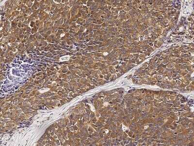 Immunohistochemistry-Paraffin: PMM2/Phosphomannomutase 2 Antibody [NBP3-00351] - Immunochemical staining of human PMM2/Phosphomannomutase 2 in human breast carcinoma with rabbit polyclonal antibody (1:5000, formalin-fixed paraffin embedded sections).