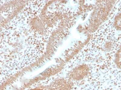 Immunohistochemistry-Paraffin: PMS2 Antibody (PMS2/4373R) [NBP3-08570] - Formalin-fixed, paraffin-embedded human colon carcinoma stained with PMS2 Recombinant Rabbit Monoclonal Antibody (PMS2/4373R).