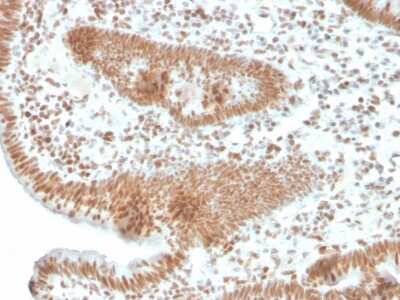 Immunohistochemistry-Paraffin: PMS2 Antibody (PMS2/4373R) [NBP3-08570] - Formalin-fixed, paraffin-embedded human colon carcinoma stained with PMS2 Recombinant Rabbit Monoclonal Antibody (PMS2/4373R).