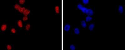 Immunohistochemistry-Paraffin: PMS2 Antibody (SY08-09) [NBP2-67069] - Analysis of paraffin-embedded human breast carcinoma tissue using anti-PMS2 antibody. Counter stained with hematoxylin.
