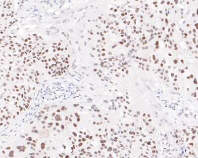 Immunohistochemistry-Paraffin: PMS2 Antibody (SY08-09) [NBP2-67069] - Immunohistochemical analysis of paraffin-embedded human breast carcinoma tissue using anti-PMS2 antibody. The section was pre-treated using heat mediated antigen retrieval with sodium citrate buffer (pH 6.0) for 20 minutes. The tissues were blocked in 5% BSA for 30 minutes at room temperature, washed with ddH2O and PBS, and then probed with the primary antibody (ET1605-1, 1/200) for 30 minutes at room temperature. The detection was performed using an HRP conjugated compact polymer system. DAB was used as the chromogen. Tissues were counterstained with hematoxylin and mounted with DPX.