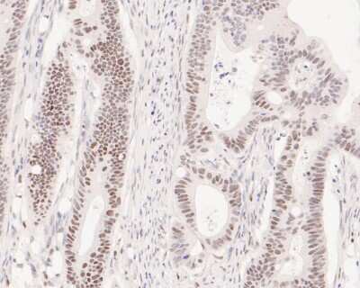 Immunohistochemistry-Paraffin: PMS2 Antibody (SY08-09) [NBP2-67069] - Immunohistochemical analysis of paraffin-embedded human colon carcinoma tissue using anti-PMS2 antibody. The section was pre-treated using heat mediated antigen retrieval with sodium citrate buffer (pH 6.0) for 20 minutes. The tissues were blocked in 5% BSA for 30 minutes at room temperature, washed with ddH2O and PBS, and then probed with the primary antibody (ET1605-1, 1/200) for 30 minutes at room temperature. The detection was performed using an HRP conjugated compact polymer system. DAB was used as the chromogen. Tissues were counterstained with hematoxylin and mounted with DPX.