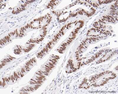 Immunohistochemistry-Paraffin: PMS2 Antibody (SY08-09) [NBP2-67069] - Analysis of paraffin-embedded human colon carcinoma tissue using anti-PMS2 antibody. The section was pre-treated using heat mediated antigen retrieval with sodium citrate buffer (pH 6.0) for 20 minutes. The tissues were blocked in 5% BSA for 30 minutes at room temperature, washed with ddH2O and PBS, and then probed with the primary antibody 1/50) for 30 minutes at room temperature. The detection was performed using an HRP conjugated compact polymer system. DAB was used as the chromogen. Tissues were counterstained with hematoxylin and mounted with DPX.