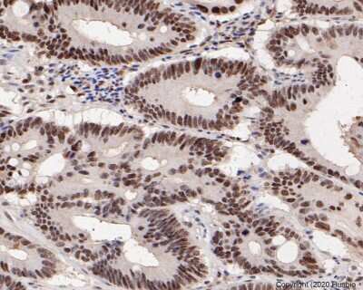 Immunohistochemistry-Paraffin: PMS2 Antibody (SY08-09) [NBP2-67069] - Analysis of paraffin-embedded human colon carcinoma tissue using anti-PMS2 antibody. The section was pre-treated using heat mediated antigen retrieval with sodium citrate buffer (pH 6.0) for 20 minutes. The tissues were blocked in 5% BSA for 30 minutes at room temperature, washed with ddH2O and PBS, and then probed with the primary antibody 1/50) for 30 minutes at room temperature. The detection was performed using an HRP conjugated compact polymer system. DAB was used as the chromogen. Tissues were counterstained with hematoxylin and mounted with DPX.