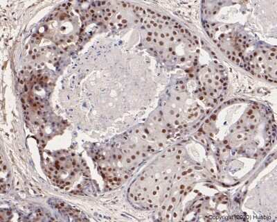 Immunohistochemistry-Paraffin: PMS2 Antibody (SY08-09) [NBP2-67069] - Analysis of paraffin-embedded human breast carcinoma tissue using anti-PMS2 antibody. The section was pre-treated using heat mediated antigen retrieval with sodium citrate buffer (pH 6.0) for 20 minutes. The tissues were blocked in 5% BSA for 30 minutes at room temperature, washed with ddH2O and PBS, and then probed with the primary antibody (1/50) for 30 minutes at room temperature. The detection was performed using an HRP conjugated compact polymer system. DAB was used as the chromogen. Tissues were counterstained with hematoxylin and mounted with DPX.