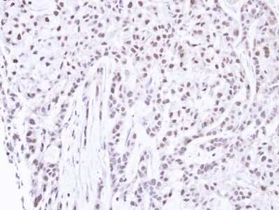 Immunohistochemistry-Paraffin: PNK Antibody [NBP1-32764] - Paraffin-embedded A549 xenograft, using antibody at 1:500 dilution.