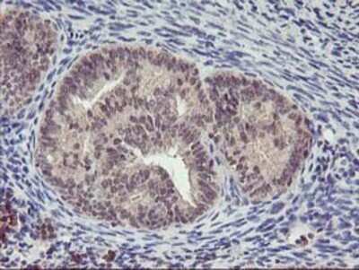 Immunohistochemistry: PNMT Antibody (OTI1D2) - Azide and BSA Free [NBP2-73494] - Staining of paraffin-embedded Adenocarcinoma of Human endometrium tissue using anti-PNMT mouse monoclonal antibody.