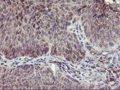 Immunohistochemistry: PNMT Antibody (OTI1D2) - Azide and BSA Free [NBP2-73494] - Staining of paraffin-embedded Carcinoma of Human bladder tissue using anti-PNMT mouse monoclonal antibody.